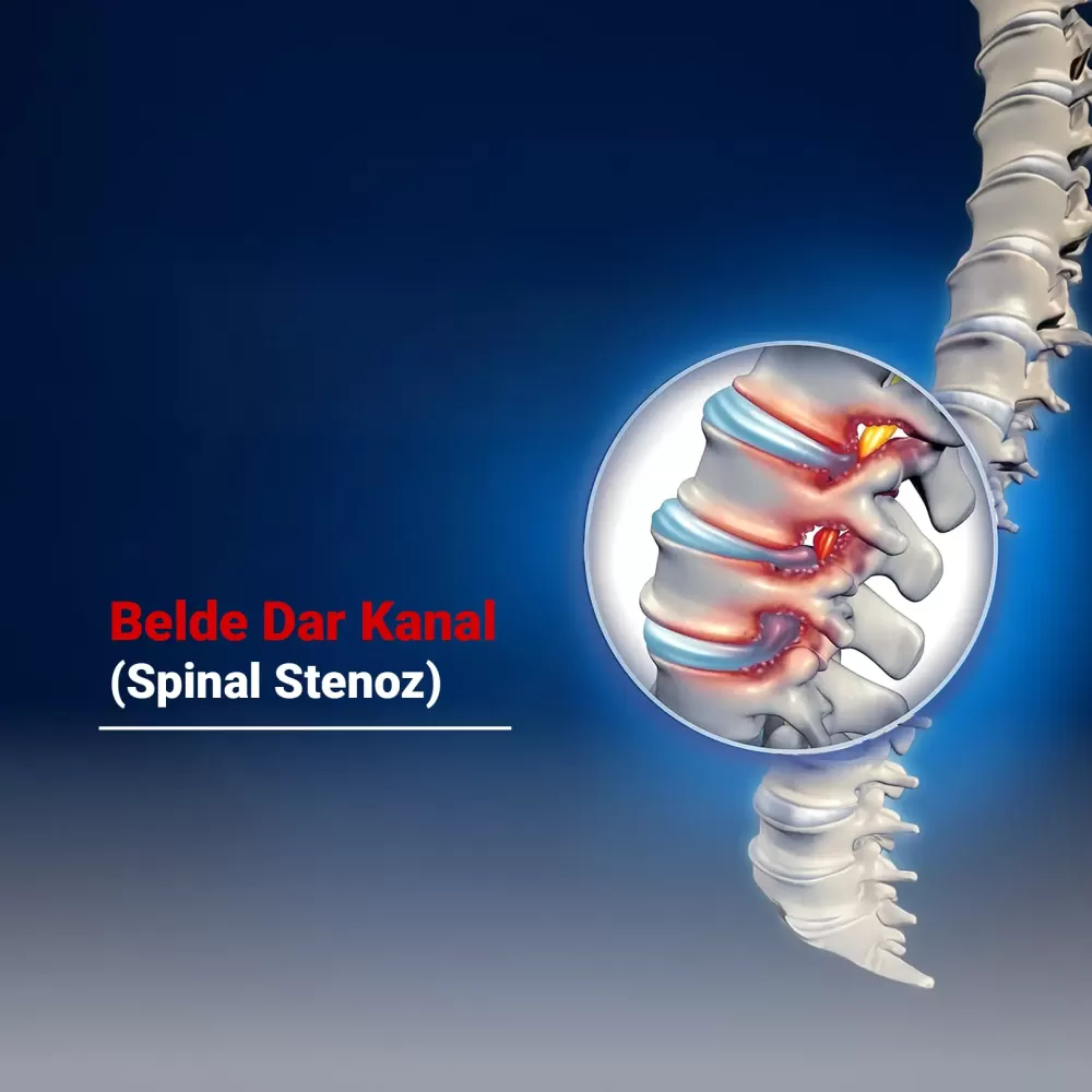 Belde Dar Kanal (Spinal Stenoz) Nedir? Belirtileri, Nedenleri ve Tedavi Yöntemleri