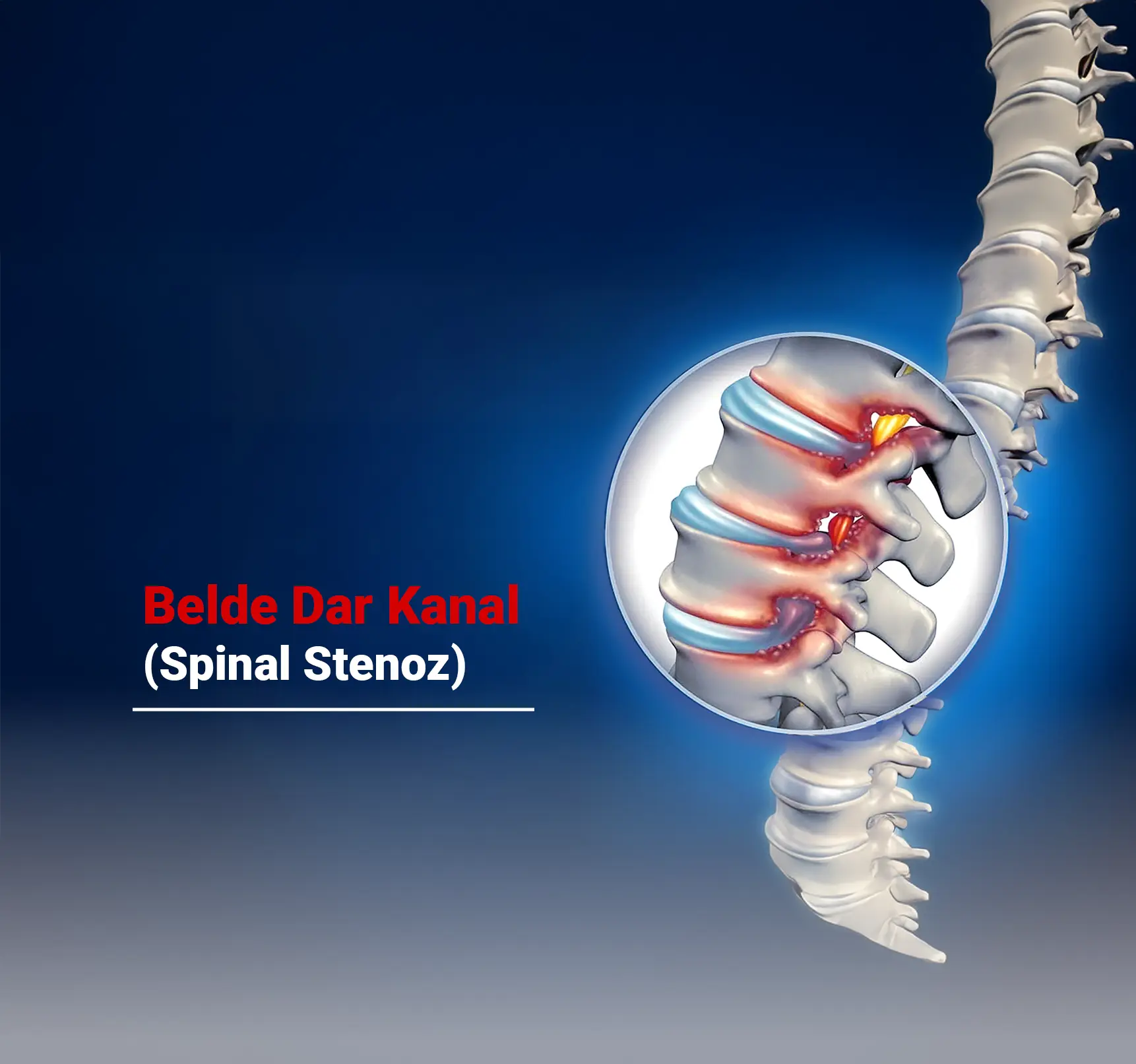 Belde Dar Kanal (Spinal Stenoz) Nedir? Belirtileri, Nedenleri ve Tedavi Yöntemleri