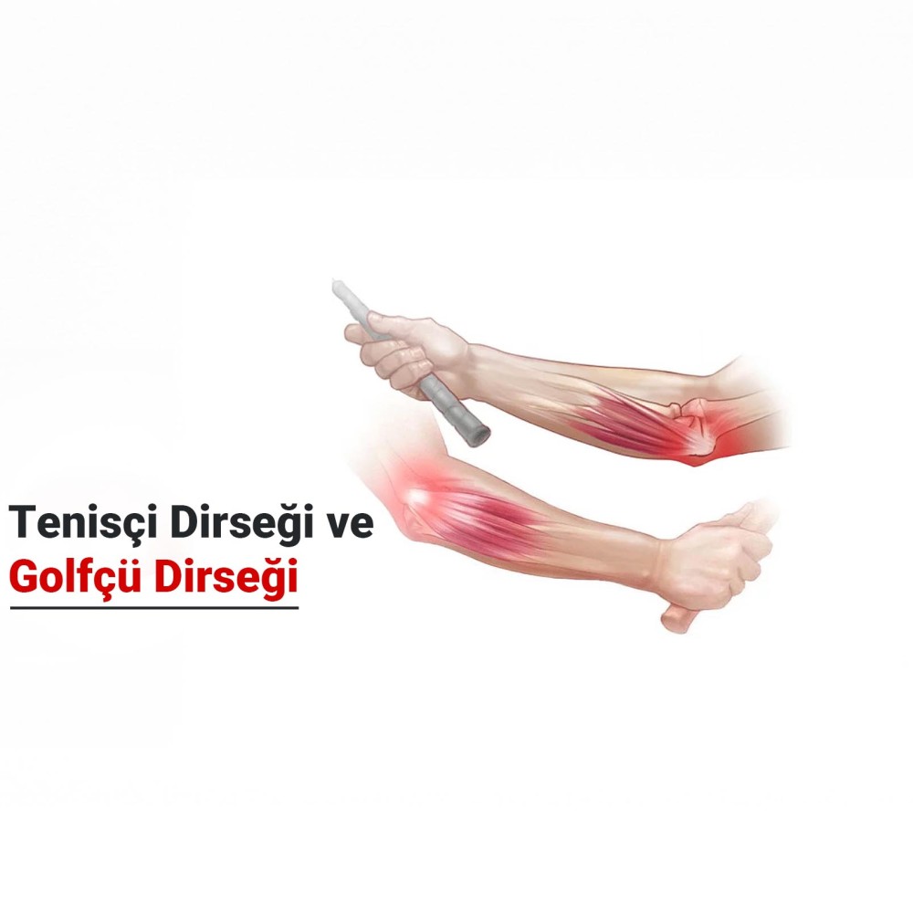 Tenisçi Dirseği ve Golfçü Dirseği