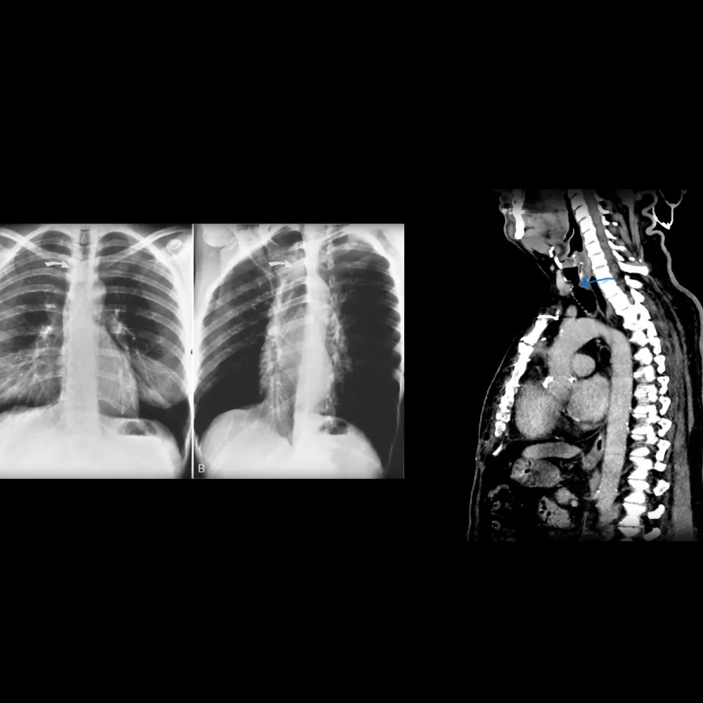 What is tracheal radiology? In what situations is it performed?