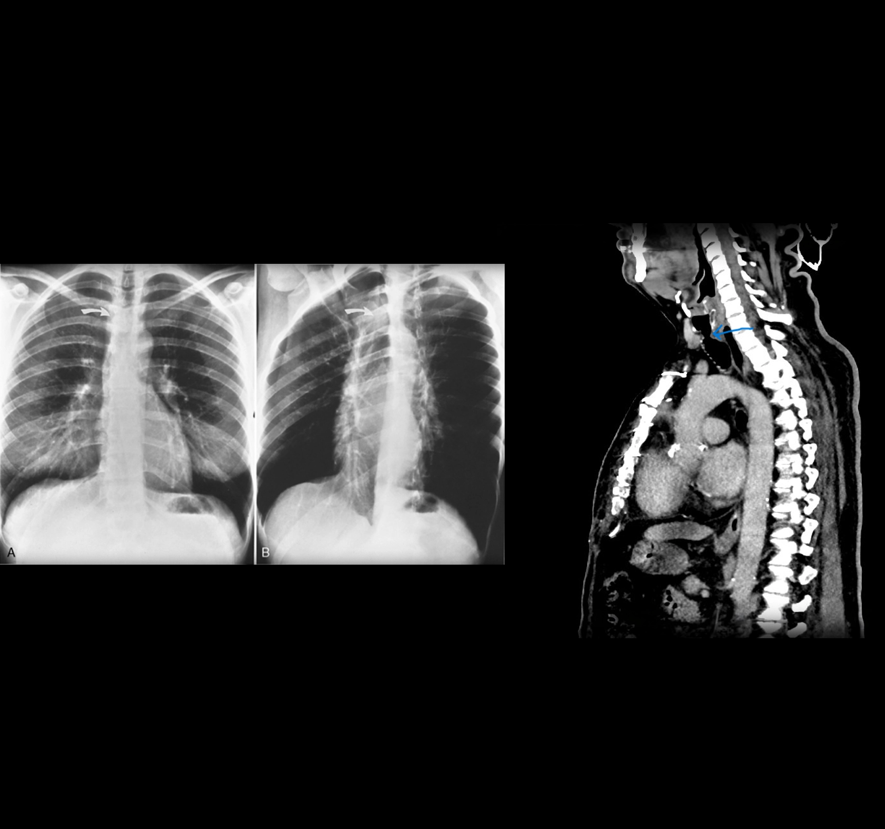 What is tracheal radiology? In what situations is it performed?