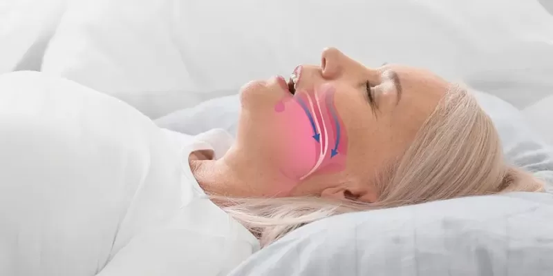 What Is Sleep Apnea? Causes, Symptoms, and Treatment