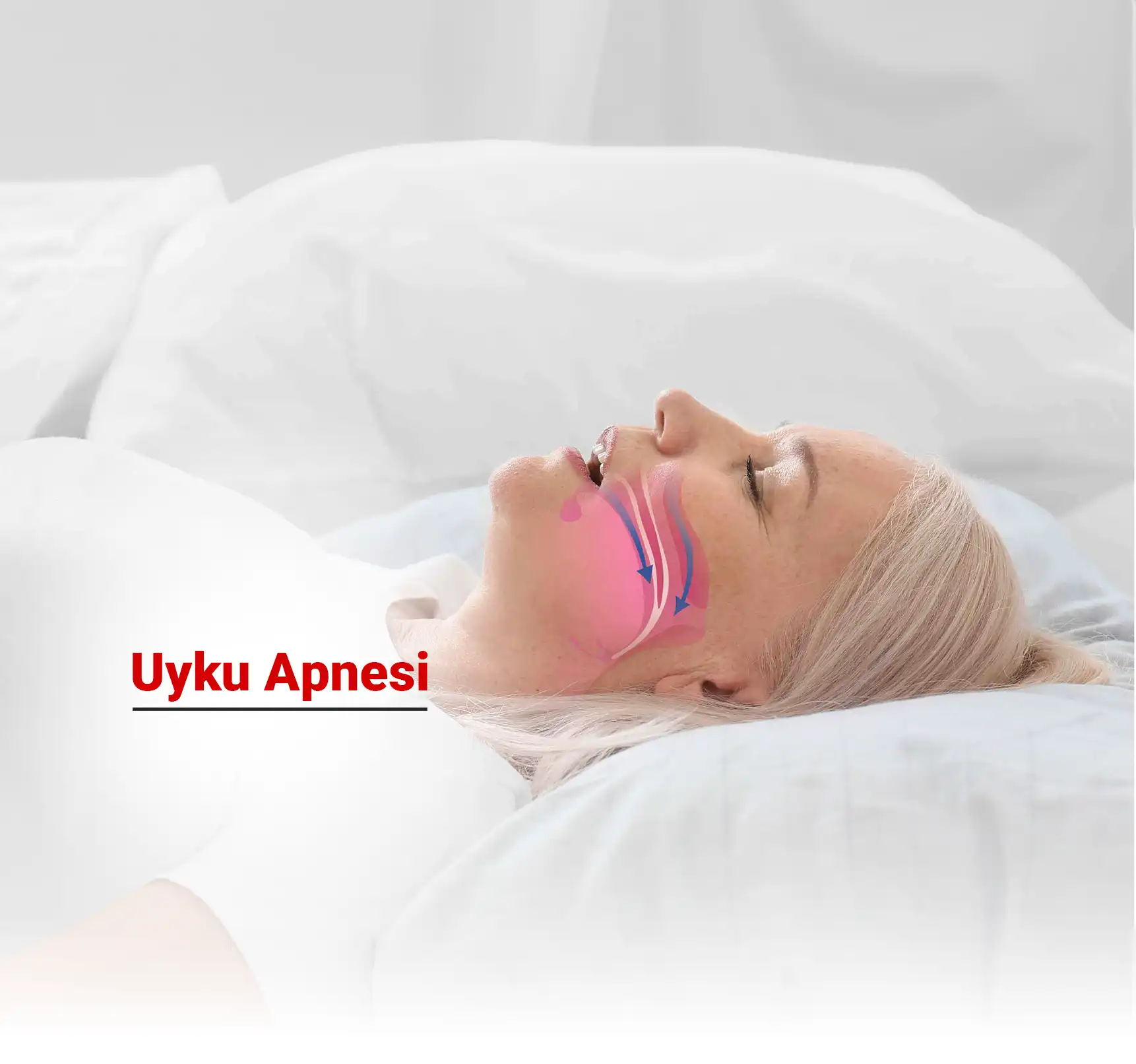 Uyku Apnesi Nedir? Neden Olur? Belirtileri ve Tedavisi