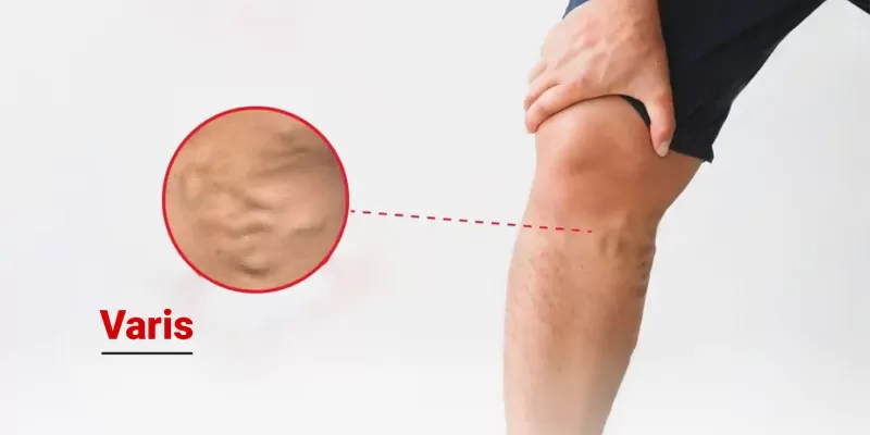 Varis Nedir? Belirtileri ve Tedavileri Nelerdir?