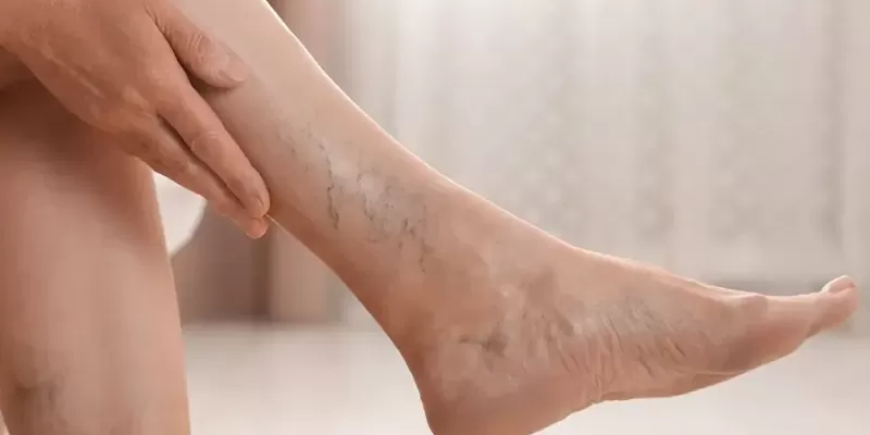 What Are Varicose Veins? What Are the Symptoms and Treatments?