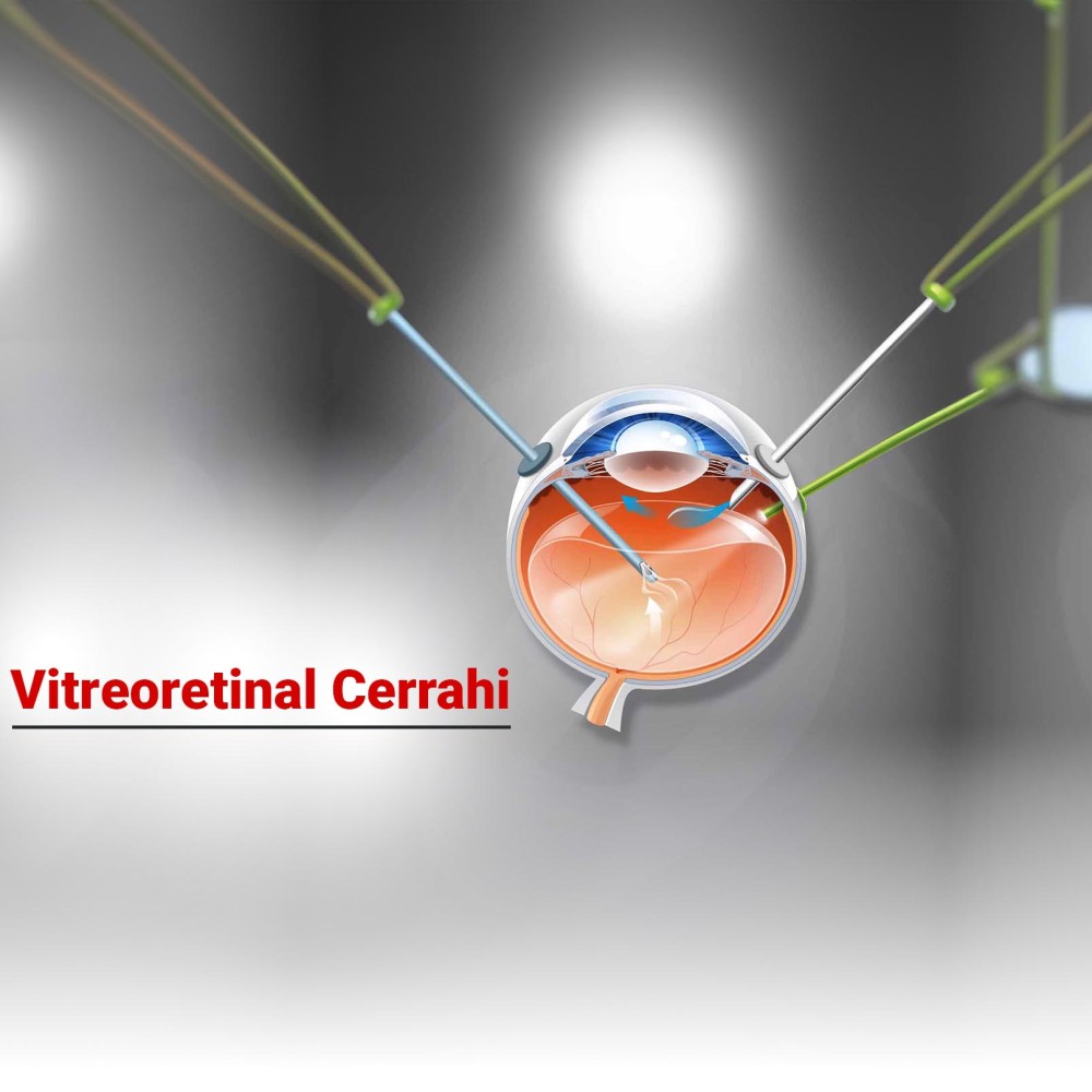 Vitreoretinal Cerrahi