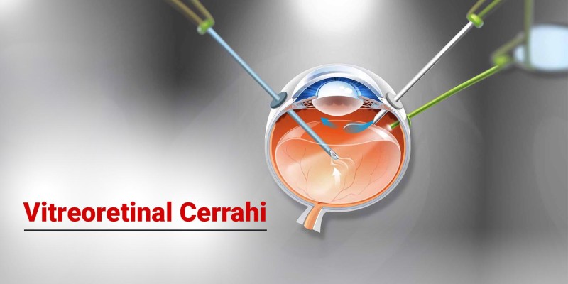 Vitreoretinal Cerrahi