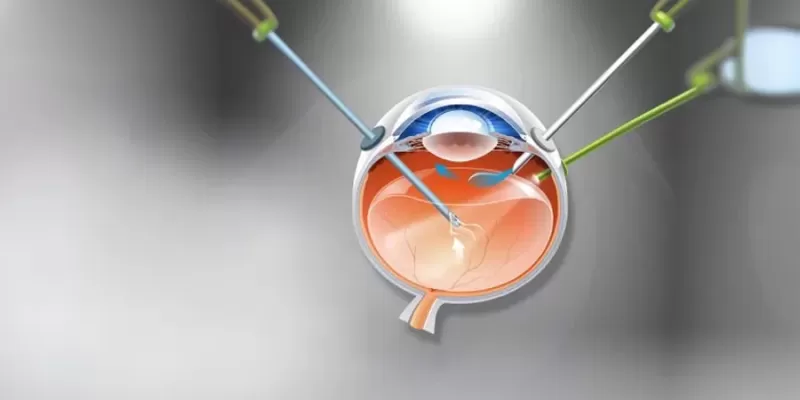 Vitreoretinal Surgery