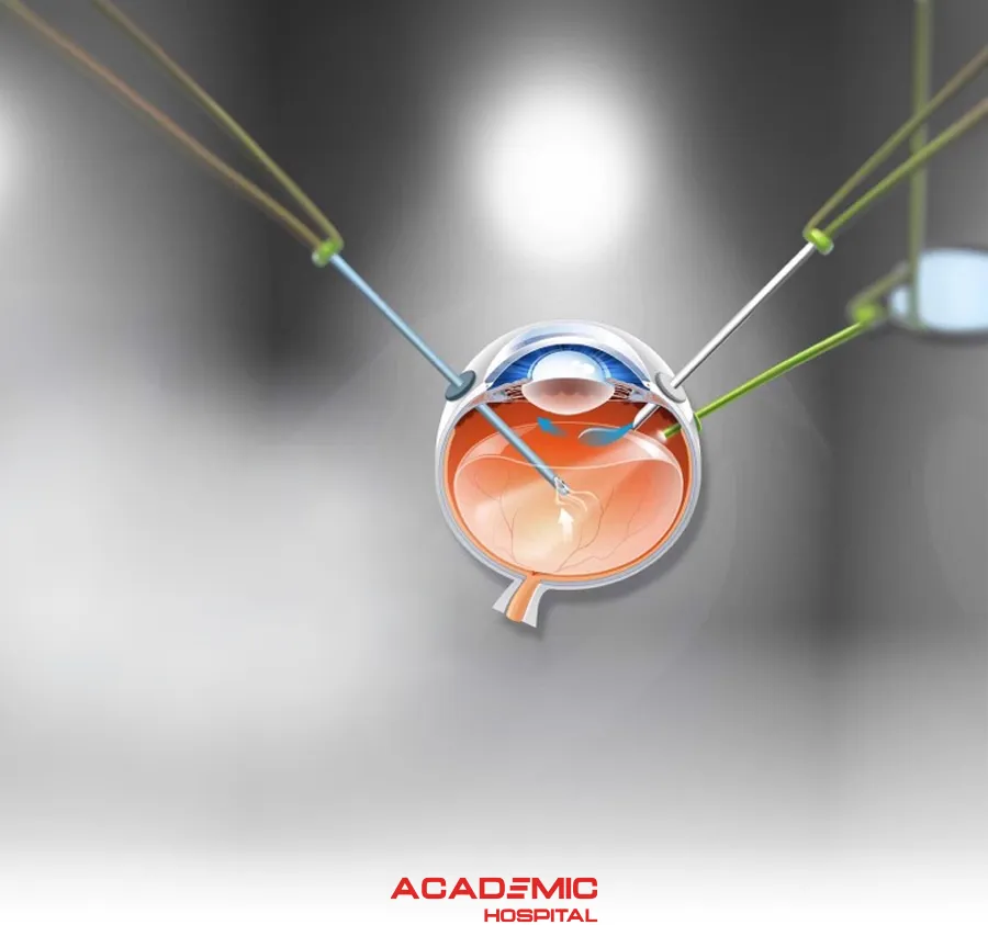 Vitreoretinal Surgery