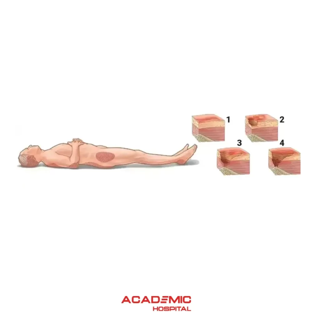 What Is a Bed Sore (Pressure Ulcer)? What Causes It? What Are the Treatment Methods?