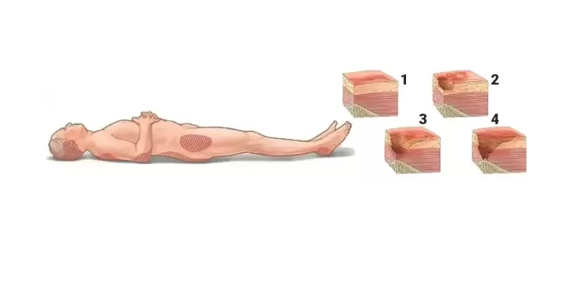 What Is a Bed Sore (Pressure Ulcer)? What Causes It? What Are the Treatment Methods?