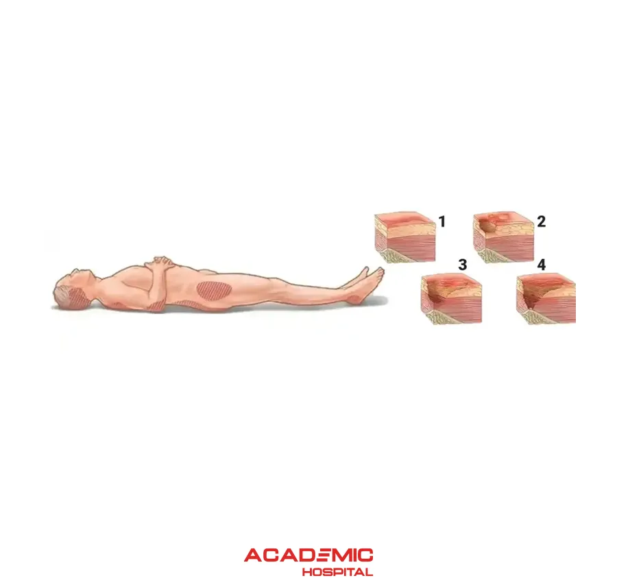 What Is a Bed Sore (Pressure Ulcer)? What Causes It? What Are the Treatment Methods?